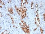 Napsin A (Lung Adenocarcinoma Marker) Antibody in Immunohistochemistry (Paraffin) (IHC (P))