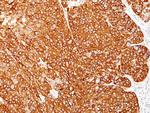 Melanoma Marker (MART-1 + Tyrosinase + gp100) Antibody in Immunohistochemistry (Paraffin) (IHC (P))