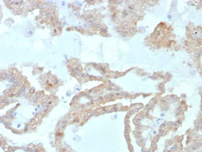 FABP2 (Marker of Metastatic Potential in Colorectal Cancer) Antibody in Immunohistochemistry (Paraffin) (IHC (P))