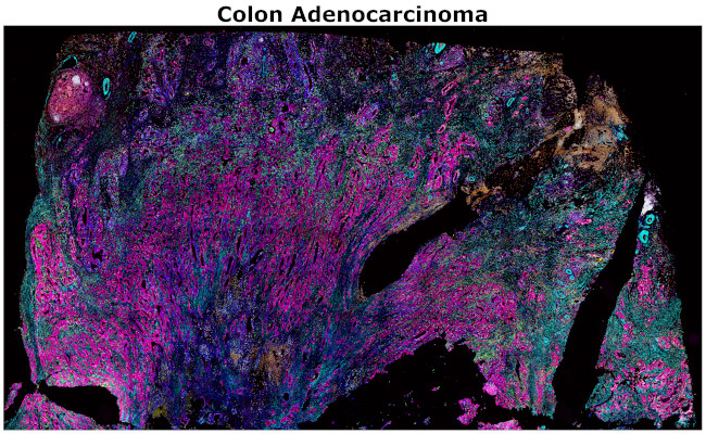 Pan Cytokeratin Antibody in Immunohistochemistry (Paraffin) (IHC (P))