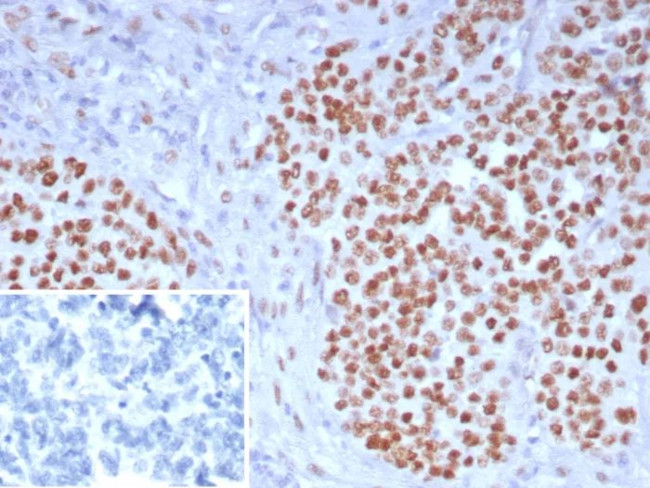 Wilm s Tumor 1 (WT1) (Wilm s Tumor and Mesothelial Marker) Antibody in Immunohistochemistry (Paraffin) (IHC (P))