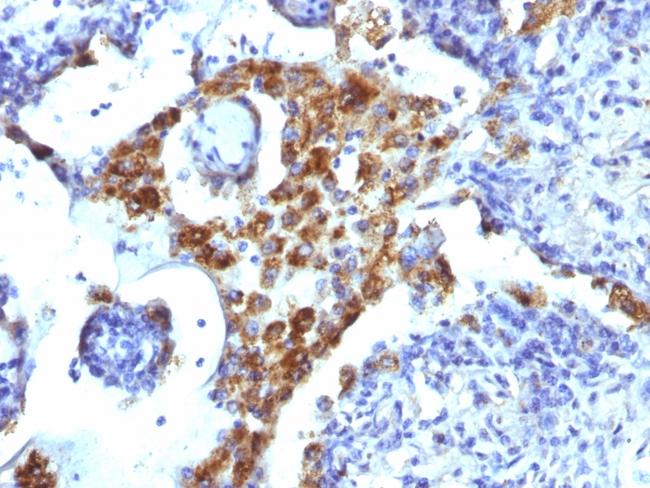 Napsin A (Lung Adenocarcinoma Marker) Antibody in Immunohistochemistry (Paraffin) (IHC (P))