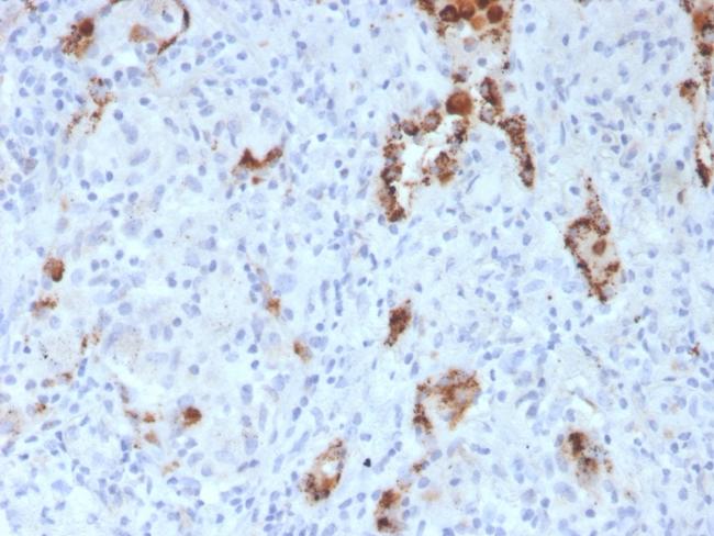 Napsin A (Lung Adenocarcinoma Marker) Antibody in Immunohistochemistry (Paraffin) (IHC (P))