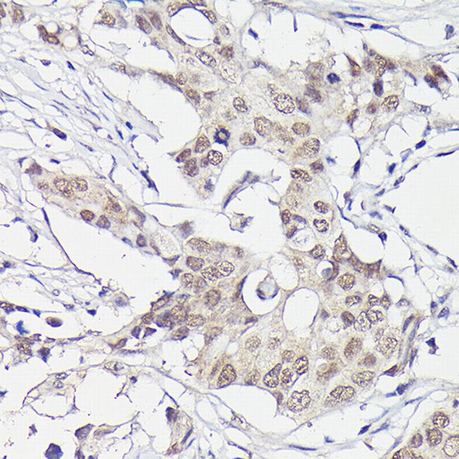 PFKFB3 Antibody in Immunohistochemistry (Paraffin) (IHC (P))