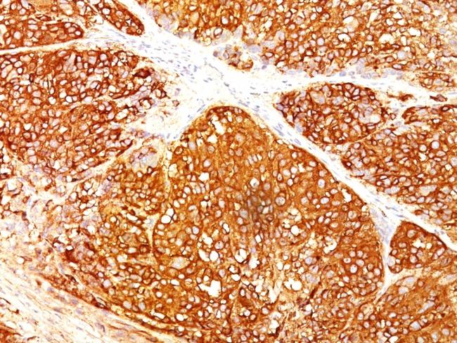 Melanoma Marker (MART-1 + Tyrosinase + gp100) Antibody in Immunohistochemistry (Paraffin) (IHC (P))