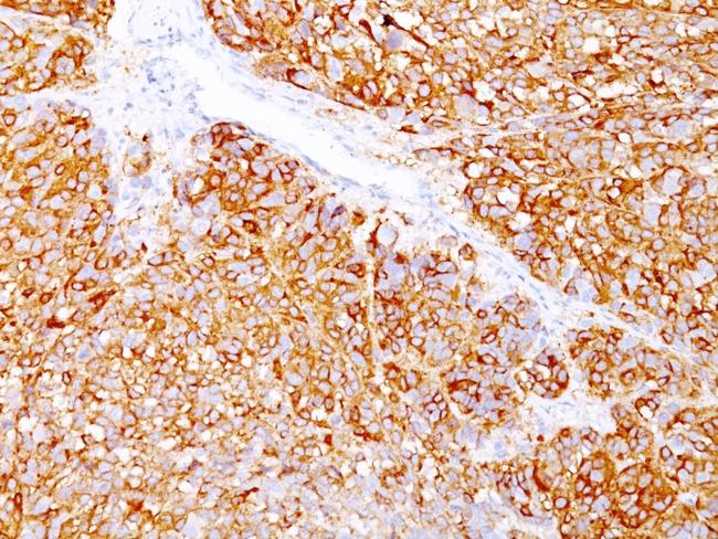 Melanoma Marker (MART-1 + gp100) Antibody in Immunohistochemistry (Paraffin) (IHC (P))